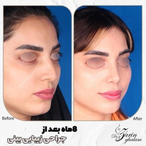 جراحی-بینی-512