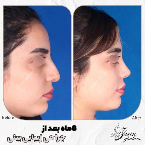 جراحی-بینی-513