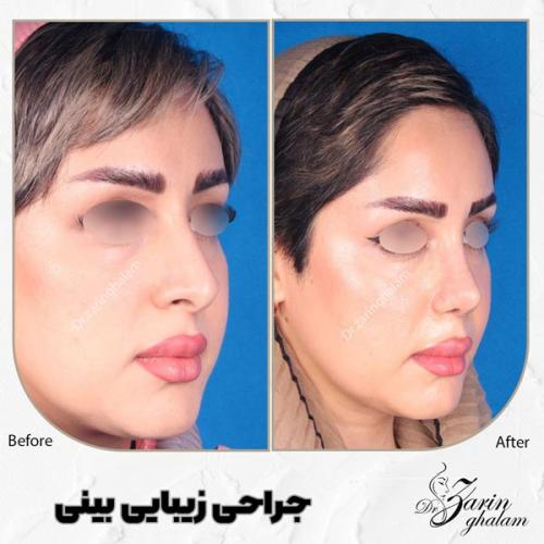 جراحی-بینی-515