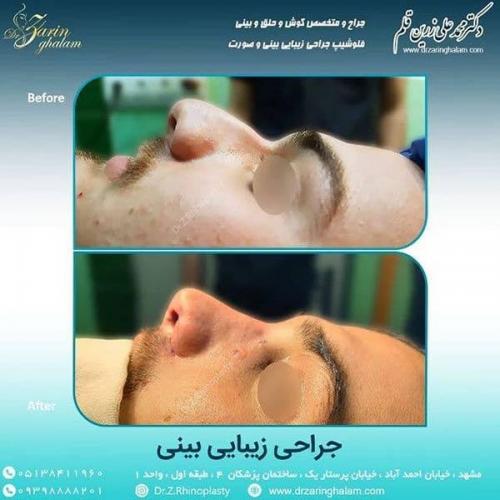 جراحی-بینی-59