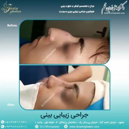 جراحی-بینی-62