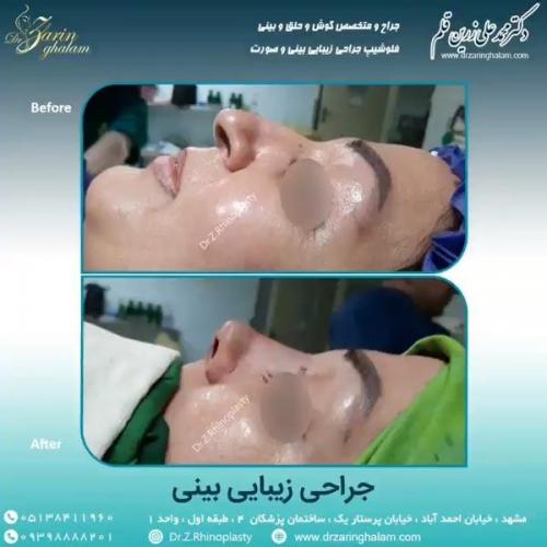 جراحی-بینی-65