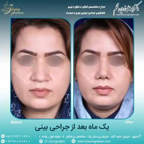 جراحی-بینی-68