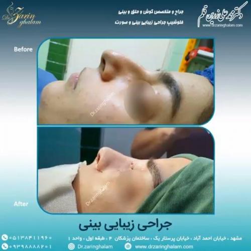 جراحی-بینی-69