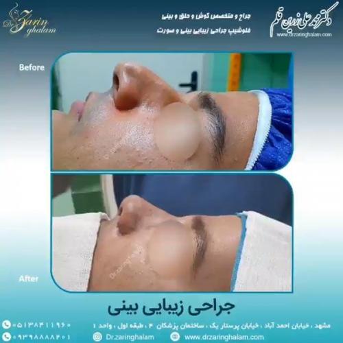 جراحی-بینی-71