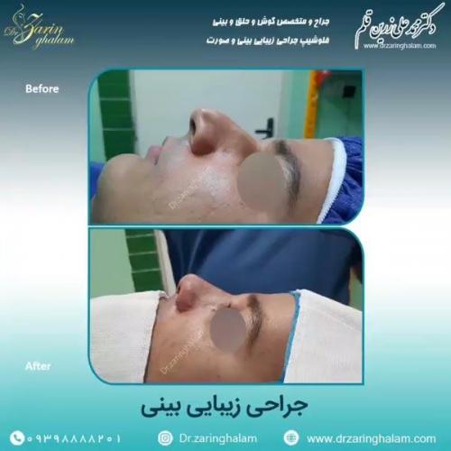 جراحی-بینی-74