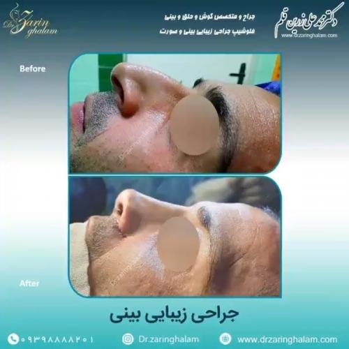 جراحی-بینی-75