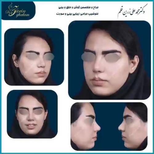 جراحی-بینی-76