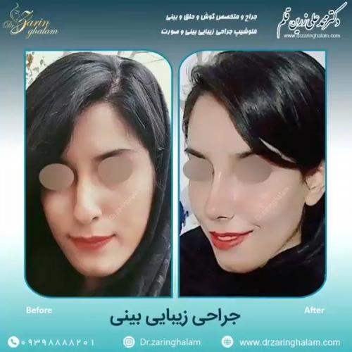 جراحی-بینی-77
