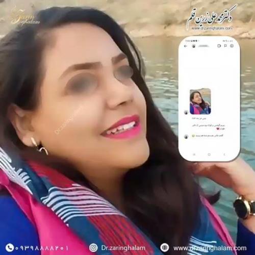 جراحی-بینی-79