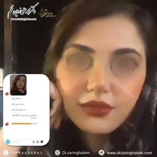 جراحی-بینی-80