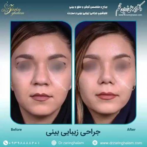 جراحی-بینی-81