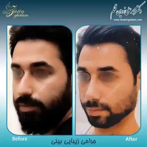 جراحی-بینی-87