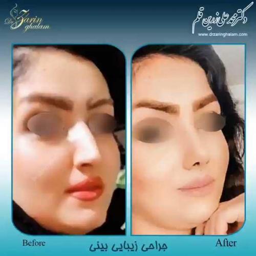 جراحی-بینی-97