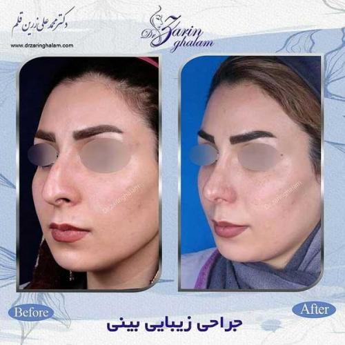 جراحی-بینی-99